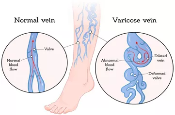 Understanding Varicose Veins and the Role of Diosmin in Venous Health